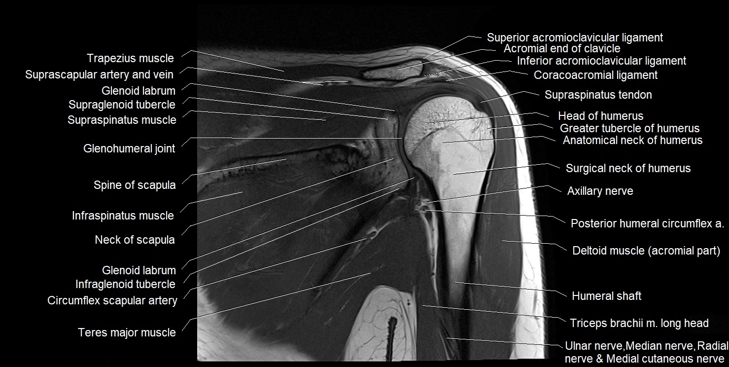 mri shoulder coronal cross sectional anatomy image 11.webp